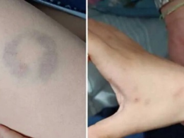 Απίστευτο περιστατικό: Διευθύντρια δάγκωσε μαθητή στην Άρτα